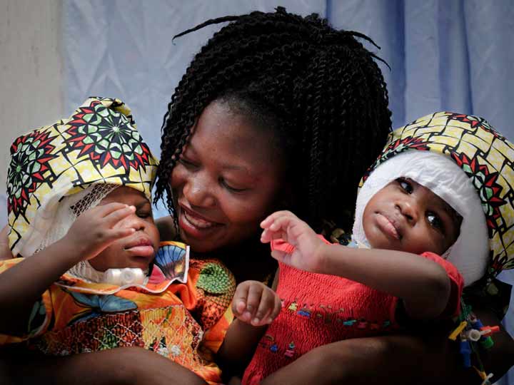 Ervina and Prefina babies twin separated in hospital bambino gesu baptized by Pope Francis