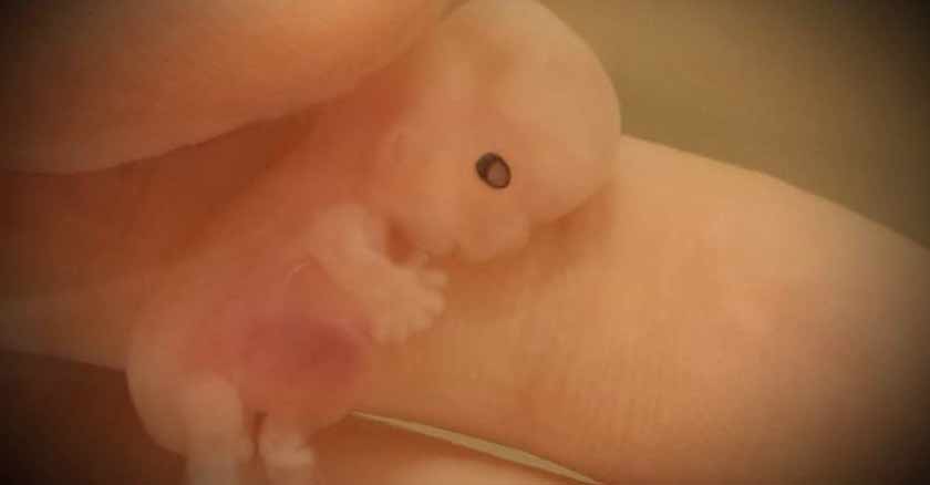 Annabelle, Bebé en aborto espontáneo. Mama Mindy viraliza fotos